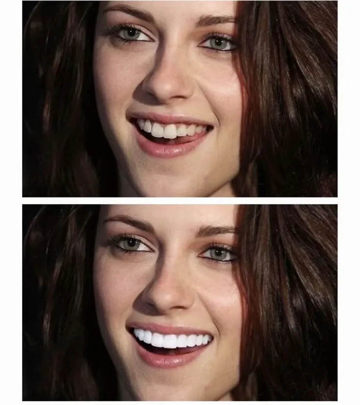 The Veneer Nightmare: When Your Smile is More Frightening Than Flirty