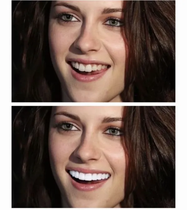 The Veneer Nightmare: When Your Smile is More Frightening Than Flirty
